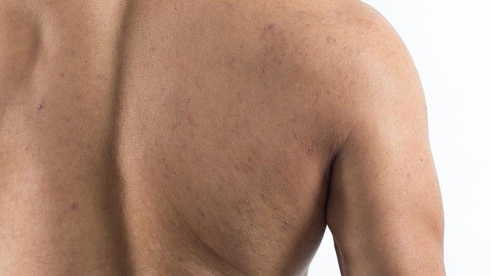 Walaupun tak terlihat, jerawat di punggung benar-benar mengganggu. Jika ini terjadi, Anda harus mencari tahu penyebabnya agar tak berulang. Foto: thinkstock Walaupun tak terlihat, jerawat di punggung benar-benar mengganggu. Jika ini terjadi, Anda harus mencari tahu penyebabnya agar tak berulang. Foto: thinkstock