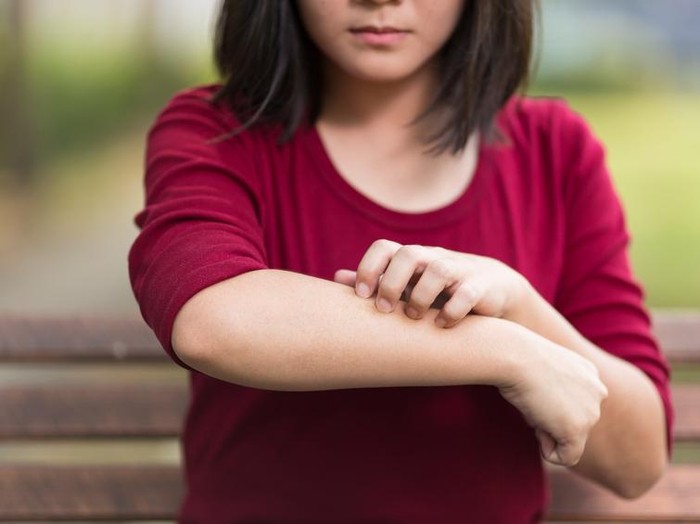 Kulit memerah dan mengelupas karena sinar matahari. Foto: iStock Kulit memerah dan mengelupas karena sinar matahari. Foto: iStock