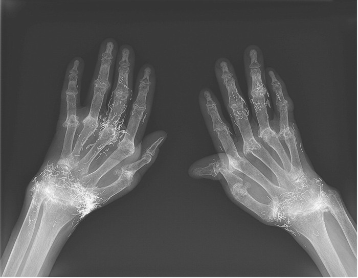 Benda aneh ditemukan dalam rontgen tangan wanita Korea Selatan. Foto: New England Journal of Medicine Benda aneh ditemukan dalam rontgen tangan wanita Korea Selatan. Foto: New England Journal of Medicine