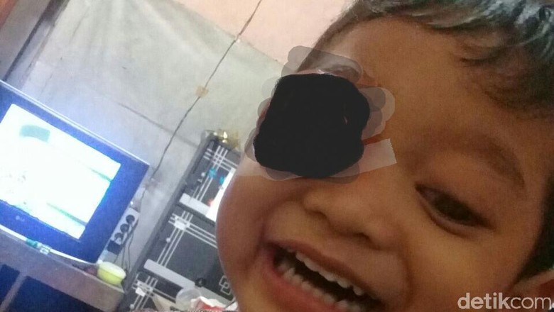 Rizwan, Bocah 3 Tahun di Kudus Idap Tumor Mata Sebesar Bola Tenis