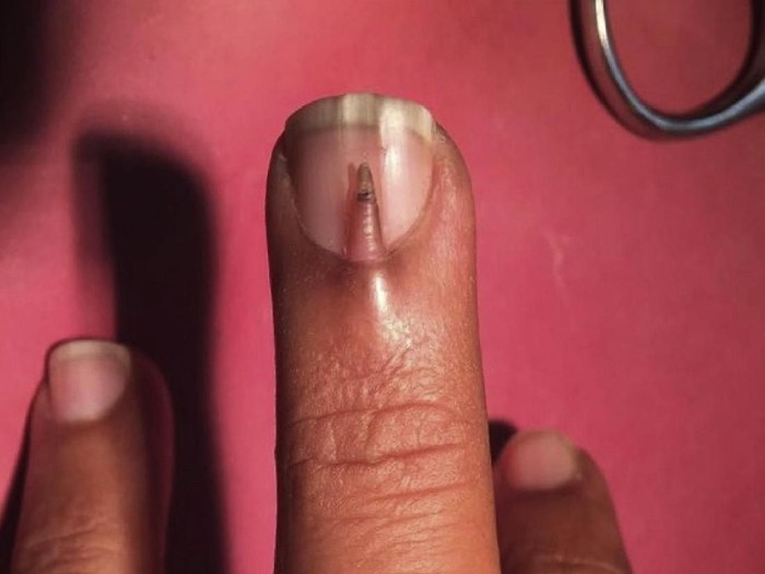Ada kuku ekstra yang tumbuh menjorok ke luar di lapisan atas kuku normal. (Foto: Journal of Surgery Open) Ada kuku ekstra yang tumbuh menjorok ke luar di lapisan atas kuku normal. (Foto: Journal of Surgery Open)