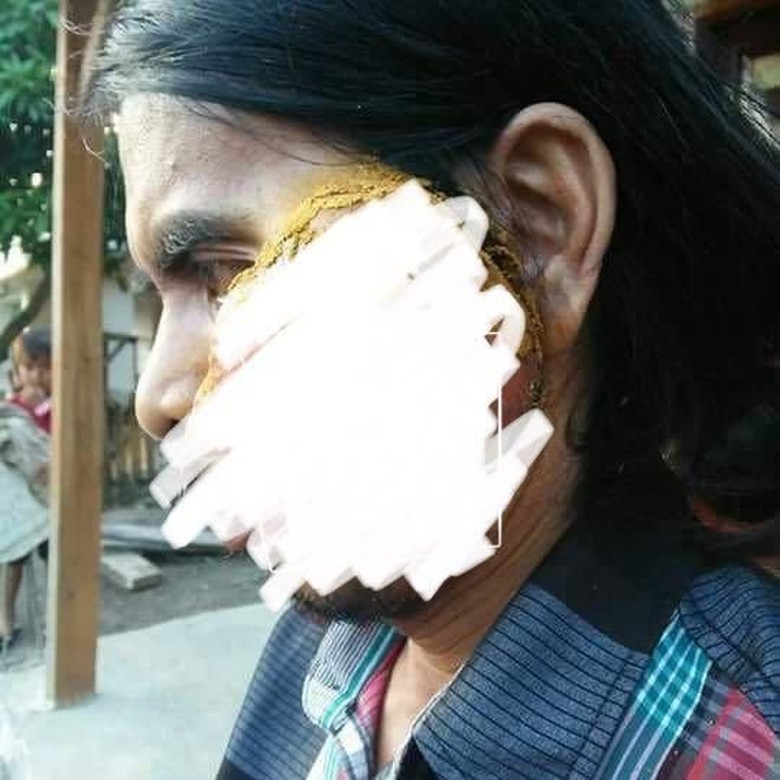 Tolong! Tumor Ganas Ini Tutupi Muka Warga NTB Tolong! Tumor Ganas Ini Tutupi Muka Warga NTB