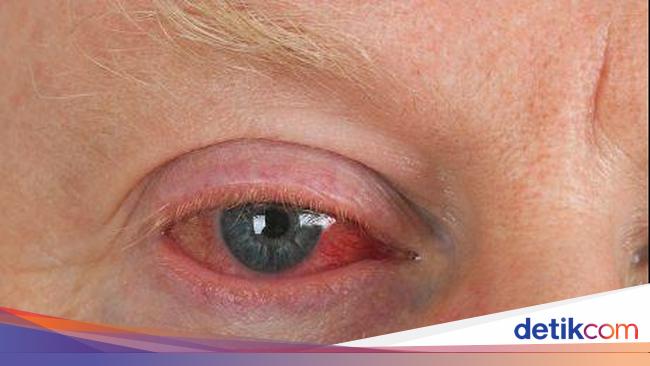 Mata Terasa Gatal Dan Memerah Tiga Hal Ini Bisa Sebabkan Konjungtivitis