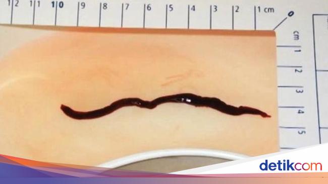 Hii Sebulan Lamanya Cacing Hitam Besar Hidup Di Hidung Bocah Ini