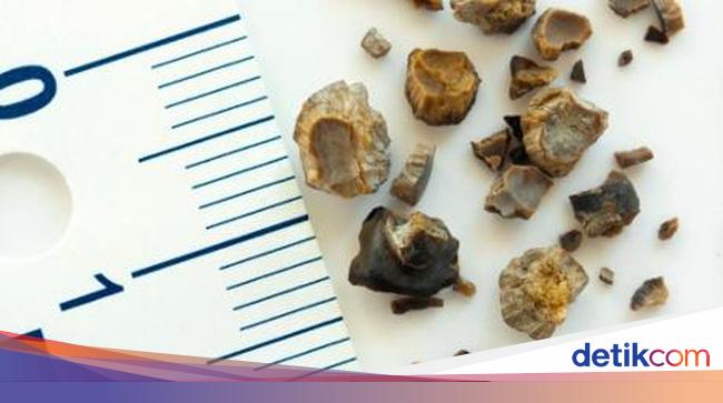 Ini Sebabnya Usai Batu Ginjal Ditembak Pasien Tak Disarankan Tidur Tiduran