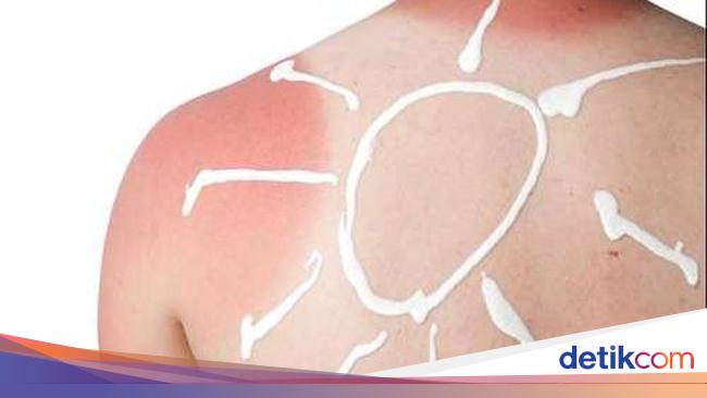 Kulit Belang Karena Matahari Bisa Kembali Normal Nggak Ya