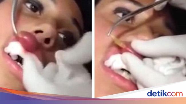 Bengkak Ternyata Ada Belatung Tinggal Dalam Bibir Wanita Ini
