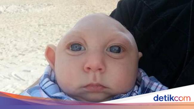 Berkepala Kecil, Bayi yang Menggemaskan Ini Berjuang Hidup