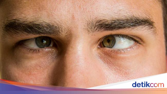 Beda Juling ke Dalam atau Luar dan Tipe Mata Juling Lainnya