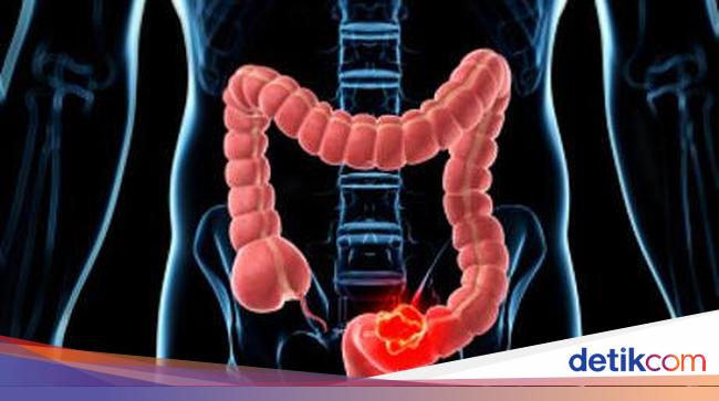 Appendicitis: Symptoms, Complications, and Treatment