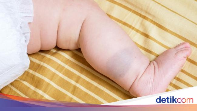 Kenali Kepribadian Berdasarkan Tanda Lahir Kamu Termasuk Yang Mana
