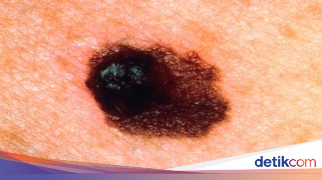 Sama-sama Kanker Kulit, Ini Bedanya Karsinoma dengan Melanoma