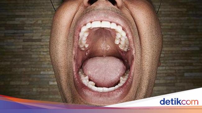 Catatkan Rekor Dunia Pria Ini Punya 37 Gigi Di Mulutnya