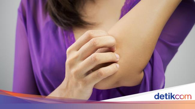 Alergi Wikipedia Bahasa Indonesia Ensiklopedia Bebas