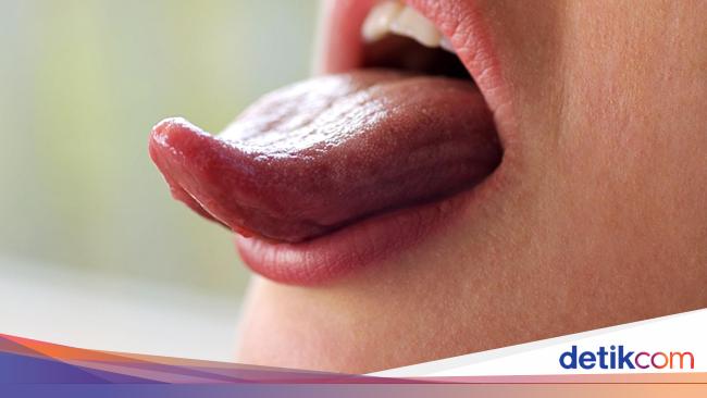 Dari Sariawan Hingga Sakit Tenggorokan Ini 5 Gejala Kanker Lidah