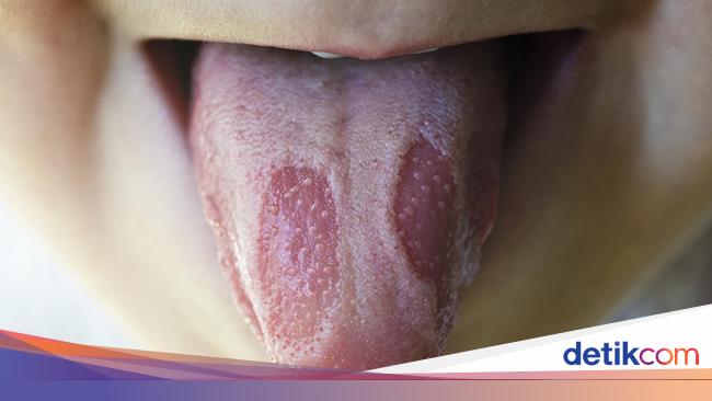 4 Kondisi Kesehatan Yang Bisa Terlihat Dari Lidahmu 1