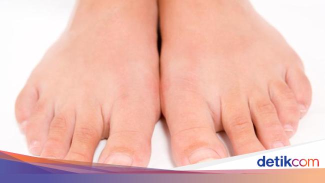 10 Cara Mencegah Dan Mengatasi Kutu Air Yang Perlu Kamu Waspadai