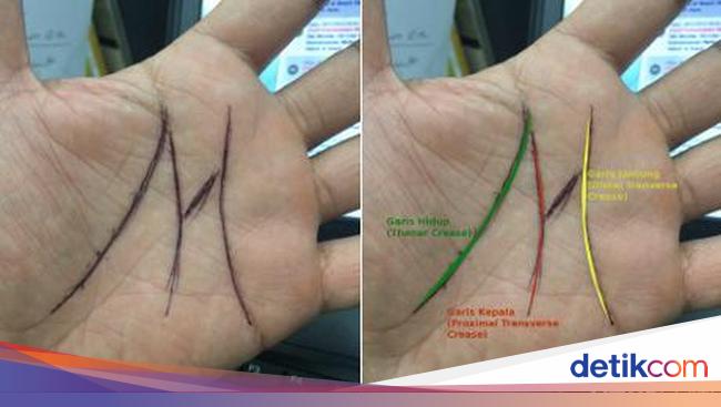 Garis Tangan Bertanda M Benarkah Istimewa Yuk Tanya Dokter