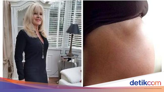 Perut Besar Seperti Ibu Hamil Kembar Ternyata Ada Kista Perut Besar Seperti Ibu Hamil Kembar Ternyata Ada Kista
