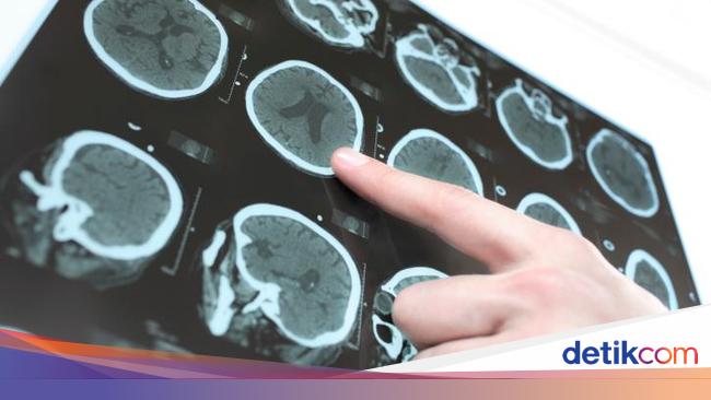 Saat Stroke Menyerang Dua Juta Sel Otak Mati Tiap Menit