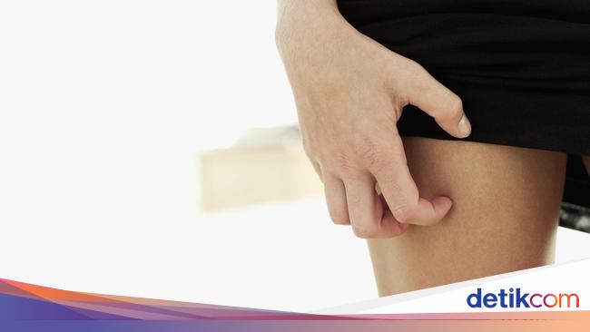 5 Penyebab Gatal Di Selangkangan Dan Cara Mengatasinya