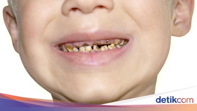 Gigi Susu Tanggal Sebelum Waktunya Gigi Tetap Bisa Tumbuh Tak Rapi