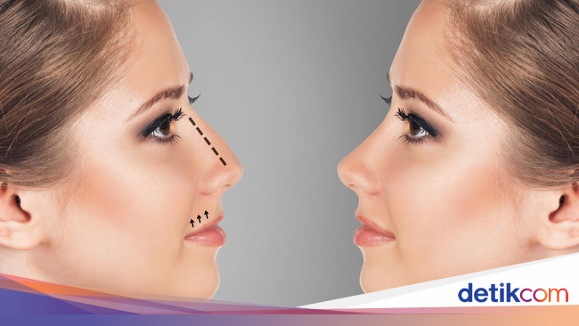 Ini Kata Dokter Tompi Tentang Bahaya Pasang Implan Hidung Ini Kata Dokter Tompi Tentang Bahaya Pasang Implan Hidung