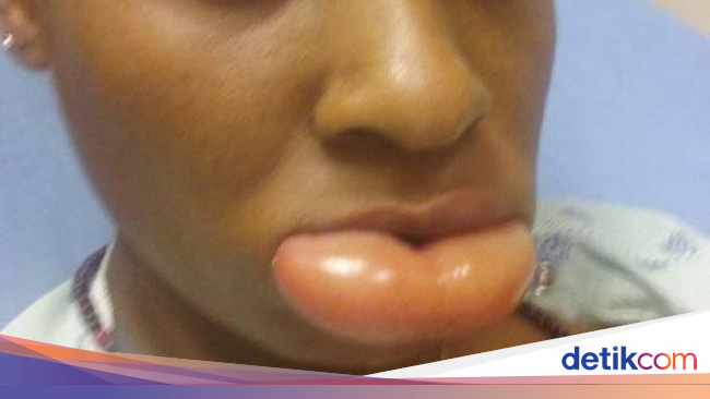 Alergi Lipstik, Bibir Wanita Ini Jadi Super Bengkak