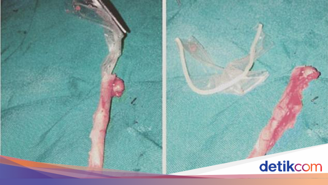 Tak Doyan Makan dan Perut Melilit Ternyata Ada Kondom 