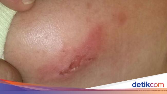 Tiba Tiba Muncul Semacam Luka Lepuh Di Kulit Bayi Apa Sebabnya