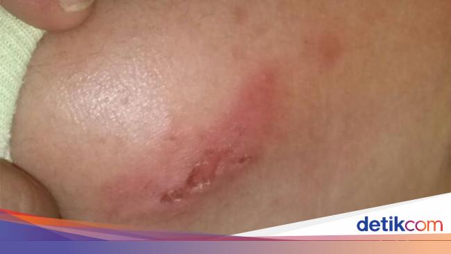 Tiba Tiba Muncul Semacam Luka Lepuh Di Kulit Bayi Apa Sebabnya