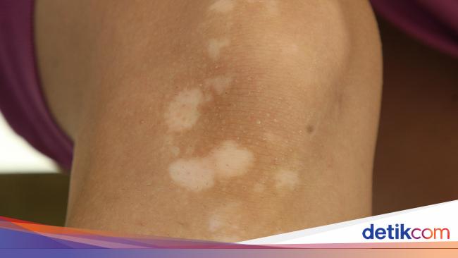 Kenali Ini 3 Tipe Vitiligo Berdasarkan Area Munculnya