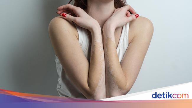 Prosedur Terapi Vitiligo Terapi Jemur Hingga Tandur Kulit Prosedur Terapi Vitiligo Terapi Jemur Hingga Tandur Kulit