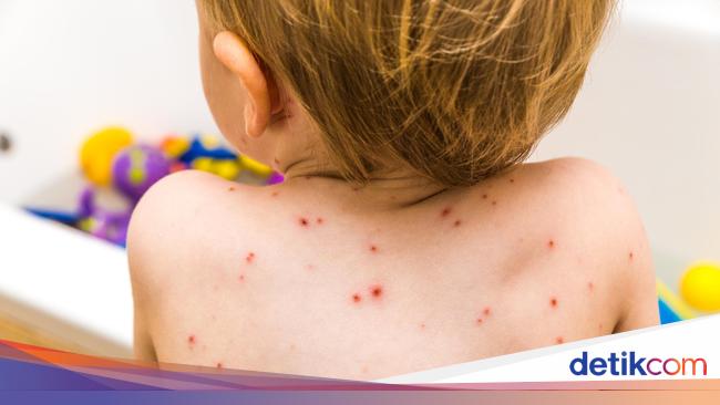 tanda hfmd sudah sembuh tanda hfmd sudah sembuh