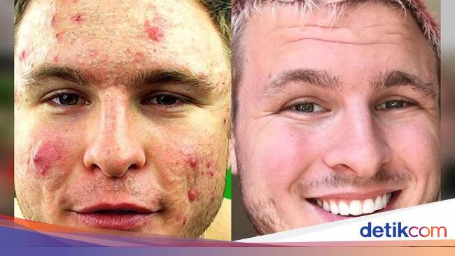 Pernah Berjerawat Parah Pria Ini Ungkap Tips Yang Buat Wajahnya