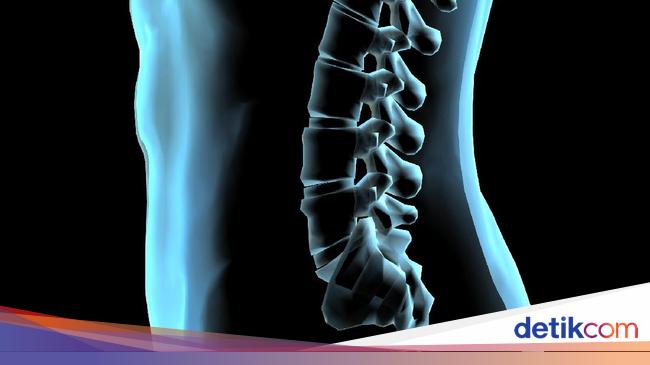 3 Jenis Kelainan Tulang Belakang: Skoliosis, Kifosis, dan Lordosis