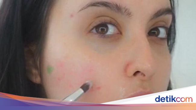 Cara Vlogger Kecantikan Hilangkan Jerawat Dalam Sekejap 