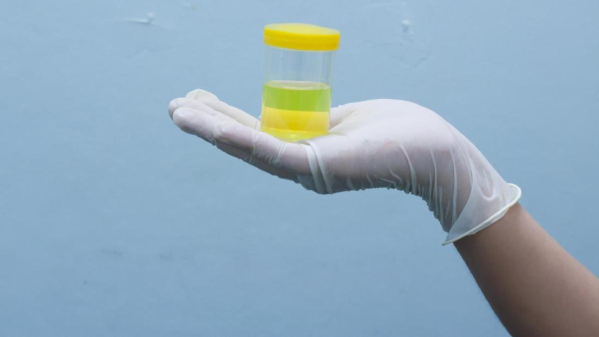 尿がこのような場合は、腎臓病または感染症の兆候である可能性があるので注意してください