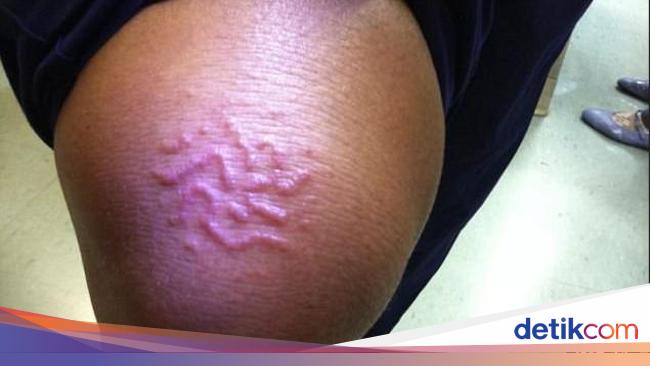 Hii Di Bawah Kulit Perempuan Ini Bersemayam Cacing Parasit