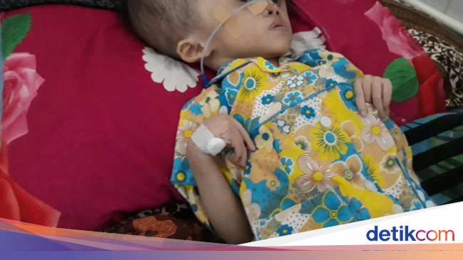 Malang Nasib Anisa, Bocah Penderita Hidrosefalus Asal 