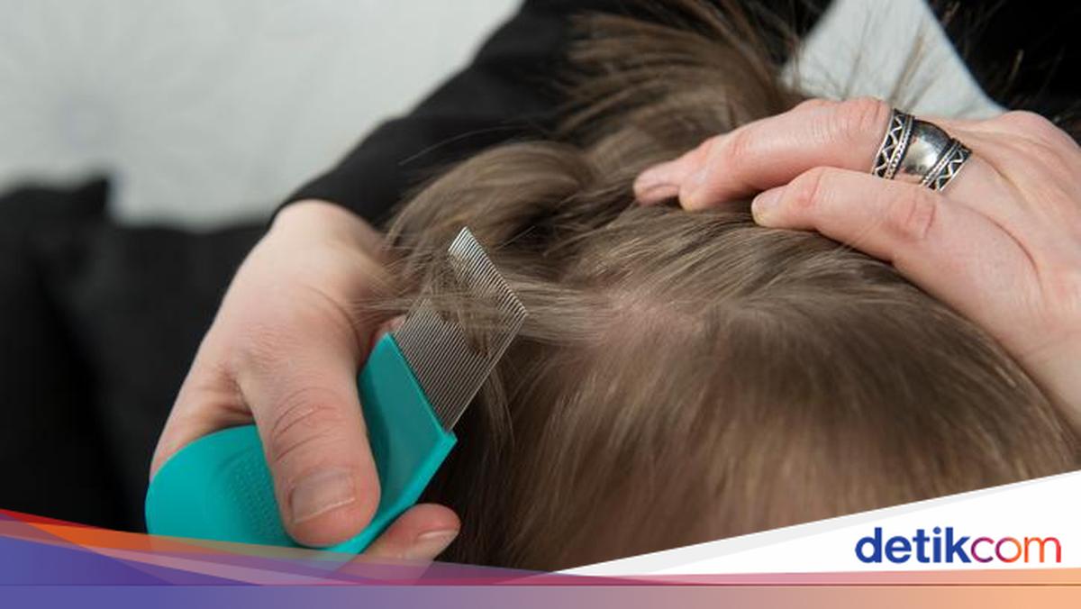 10 Cara Membasmi Kutu Rambut Beserta Telurnya, Mudah dan Cepat!