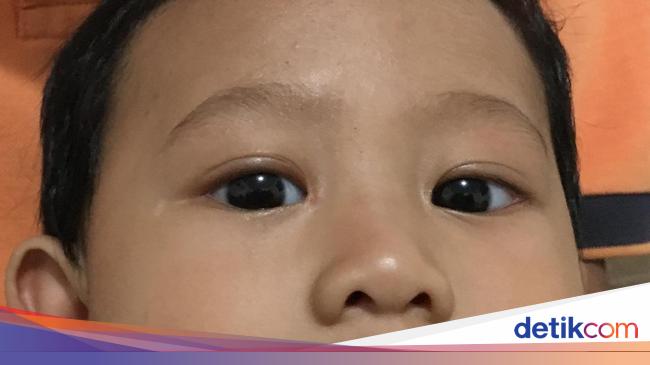 Mata Juling dan Menyala Saat Kena Sinar Waspadai Mata Juling dan Menyala Saat Kena Sinar Waspadai