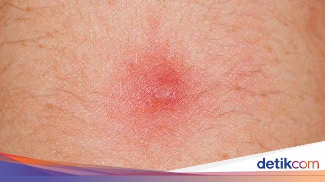 Tentang Benjolan di Ketiak, Kenali dari Awal!