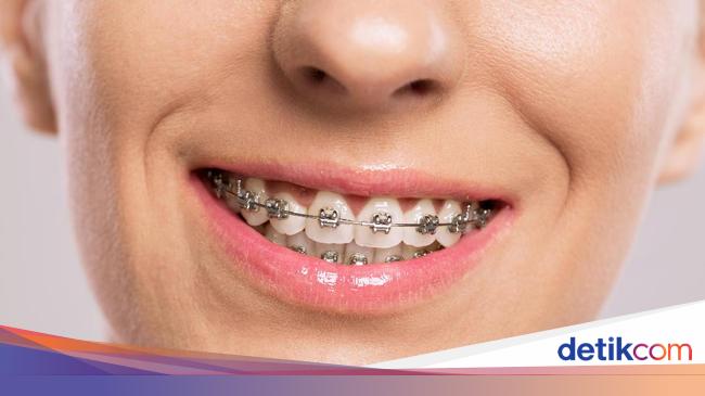 Mau Pasang Behel Ketahui Kesalahan Saat Pakai Kawat Gigi Mau Pasang Behel Ketahui Kesalahan Saat Pakai Kawat Gigi