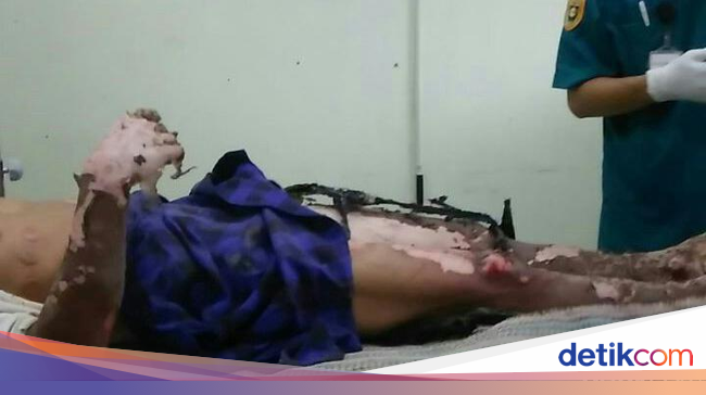 Tersengat Listrik, Tukang Bangunan di Purworejo Luka Bakar 