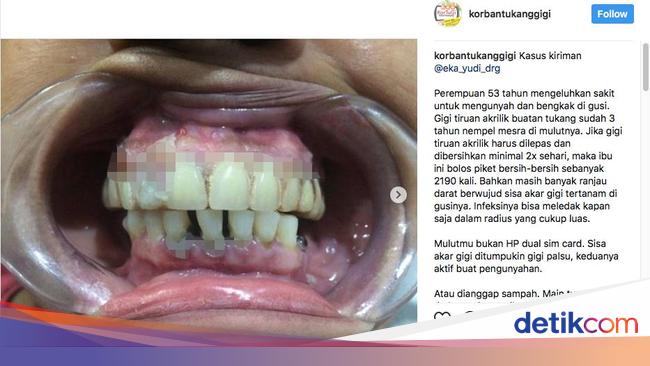 Apa Solusi Gigi Geraham Tinggal Akar Dan Posisi Gigi Tidak Rata Dok Tribunnews Com Mobile