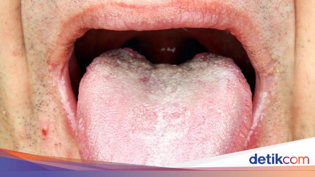 Sariawan Di Samping Lidah Bagaimana Mengobatinya