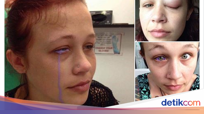 Seram Gara gara Tato Mata Gadis Ini Hampir Kehilangan Seram Gara gara Tato Mata Gadis Ini Hampir Kehilangan