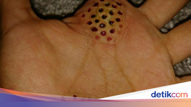 Potret Efek Spesial Yang Bisa Bikin Merinding Si Pemilik Trypophobia