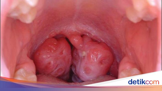 13 Gejala Radang Amandel Yang Harus Diwaspadai